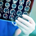 Beyin tümörlerinde en önemli risk faktörü radyasyon: İşte beyin tümörü belirti, tanı ve tedavi yöntemleri