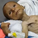 Yetersiz beslenme nedeniyle Gazze'de 2 aylık bebeğin yaşamı tehdit altında