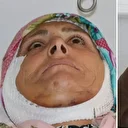 15 yıldır yüz felci olan kadın ameliyat sonrası yeniden gülümsedi