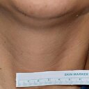 Tiroidin her çeşidi kanserli değil