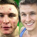 Sivilce probleminden böyle kurtuldu