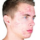 Sivilceyi bir gecede geçiren yöntem