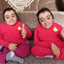 Cam kemik hastası ikizler: Birinin kemiği kırılınca diğeri de hissediyor