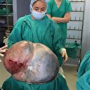 Yaşlı kadından çıkan tümör rekor kırdı
