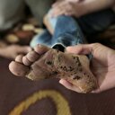 Vücudu çürümeye başlayan kız ölüm kalım savaşı veriyor