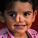 'Çift burunlu' minik Öykü sağlığına kavuşmak istiyor