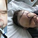 Göz kanseri hastanın yüzünde delik oluştu