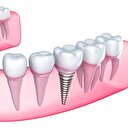 Diş eksikliğine implantlı çözüm