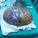 4,5 kiloluk kitle organlara yapıştı