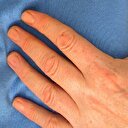 İlerleyen egzama kalp rahatsızlığı riskini arttırıyor