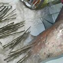 Doktorlar şaşkın: Vücudundan 70 tane iğne çıktı
