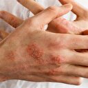 Egzamadan tamamen kurtulmak mümkün