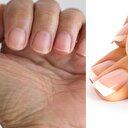 Tırnak problemleri hastalıkların habercisi