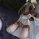 Köpeğinden kaptığı bakteri yüzünden uzuvlarını kaybetti