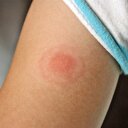 Uzmanlar uyarıyor: Lyme virüsü çok tehlikeli