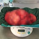 Karnından 13 kilo tümör çıkarıldı