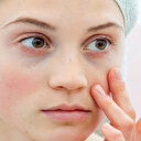 Lupus hastalığı nedir, belirtileri nelerdir?