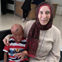 Bir gözünü kaybetti vücudu yandı