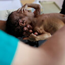 En feci insanlık felaketi: Yemen ölüyor
