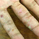 Lupus hastalığı nasıl tedavi edilir, neden olur?