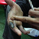 Uzuvlarını kaybeden sigara tiryakisi: Vazgeçmem