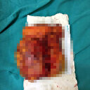 Göğsündeki şişkinlik doktorları şoke eden bir kitleymiş