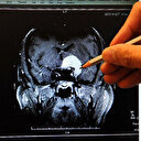 Anevrizmalar genellikle belirti vermiyor