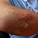 Yaraları çabuk iyileştiren bandaj geliştirildi