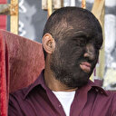 Saçları yüzünde çıkan hipertrikoz hastası: Gurur duyuyorum