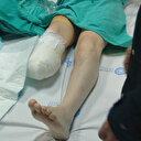 Ameliyattan sonra enfeksiyon kapan bacağı kesildi