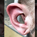 Kulağının içini ameliyatla aldırdı