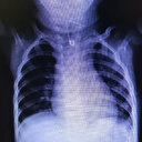 Bebeğin yemek borusundan çengelli iğne çıkarıldı