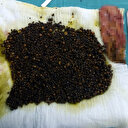 Safra kesesinden sayılamayacak kadar çok sayıda taş çıktı