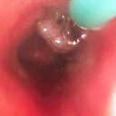 Solunum güçlüğü çeken genç kadının akciğerinden karanfil çıktı