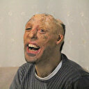 Vücudu yanan Mehmet Ali’nin dramı: Ben öldükten sonra oğluma kimse bakamaz