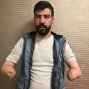 Türkiye’nin 4’üncü çift kol nakli yapılan hasta uyandı: Sağlık durumu iyi