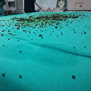 Safra kesesinden tam 3 bin 765 taş çıktı