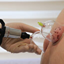 Hacamat şifa kaynağı olmaya devam ediyor