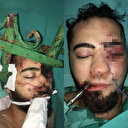 Yüzüne demir saplanmış itfaiye ekibiyle ameliyat edilmişti: Taburcu olmaya hazırlanıyor