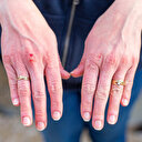 Anti alerjik ilaçlara rağmen geçmeyen kaşıntı ve döküntü ile ortaya çıkan kurdeşen de koronavirüs belirtisi olabilir