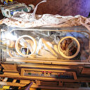 Vücutlarından birbirlerine yapışık doğan siyam ikizleri Ankara'ya getirildi