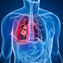 Erkeklerde birinci kadınlarda ikinci ölümcül kanser türü: Sigara kullanımına bağlı akciğer kanserinde umut artıyor!