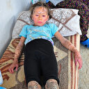 Günden güne eriyor: Balık pulu hastası Zahide tedavi olup yaşıtları gibi oynamak istiyor