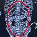 İstanbul Havalimanı'nda ele geçirildi: Yolcunun midesinden bin 844 gram kokain çıktı
