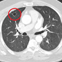 Dünya tıp literatüründe bir ilk: Covid-19 akciğer kanserini taklit etti