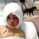 Gaziantep'te pitbull saldırısına uğrayan minik Asiye'den güzel haber: Balon tekniğiyle saçlarına kavuşacak