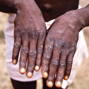 Maymun çiçeği virüsü alarmı: 12 ülkede görüldü