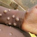 DSÖ Maymun Çiçeği Virüsü'nün nasıl bulaştığını açıkladı