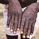 Maymun çiçeği virüsünde çarpıcı bulgular