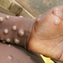 Uşak'ta maymun çiçeği virüsü paniği: İl Sağlık Müdürlüğü açıklama yaptı